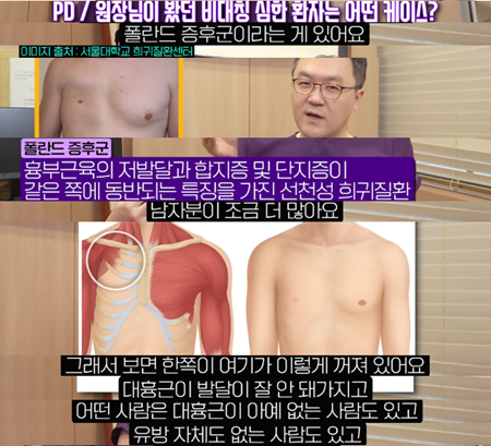<신유외과> 짝가슴 교정이 정말 필요한 사람들/유방암 재건 , 폴란드 증후군, 심한 비대칭...