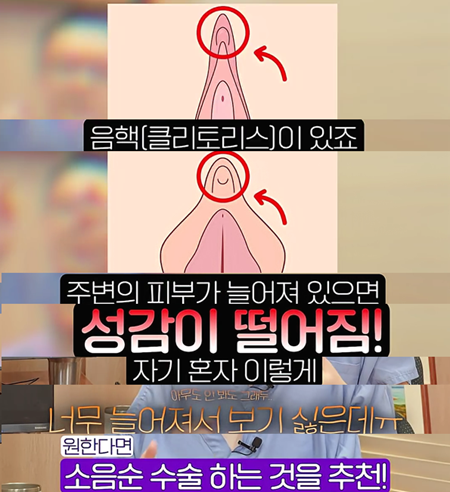 소음순수술이 필요한 경우는? 사진 2